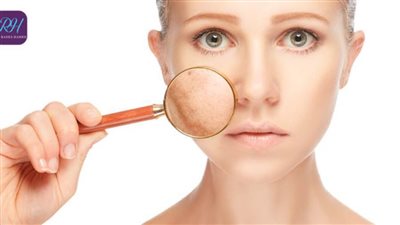 الفراكشنال .. الحل الأمثل لعلاج تصبغات البشرة