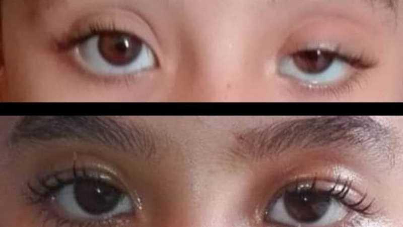 جراحة العيون