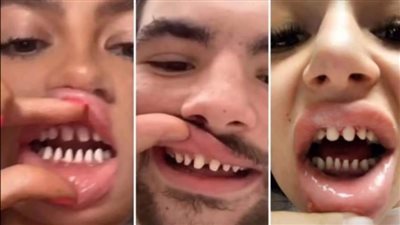 تسبب ضعف طبقة المينا.. احذر برد الأسنان بمبرد الأظافر