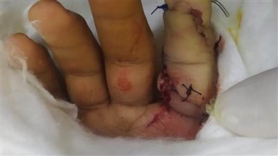 جراحة ميكروسكوبية دقيقة لزرع أصبع سبابة تعرض لبتر كامل