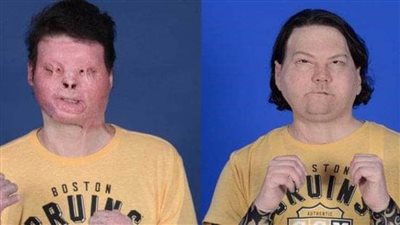 تفاصيل نجاح أول عملية زرع وجه ويدين في العالم