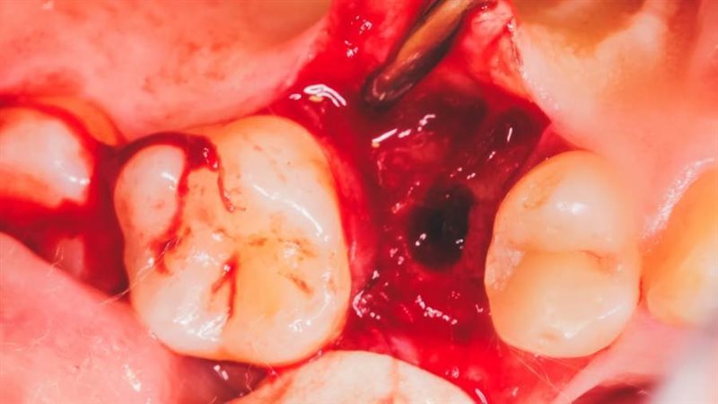 جراحة زراعة أسنان