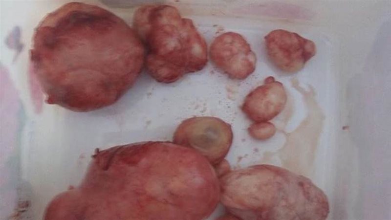 جراحات استئصال الأورام