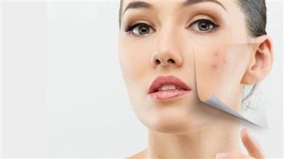 أحذري .. 5 أنواع من الأطعمة تسبب ظهور حب الشباب