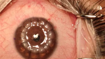 لأول مرة برمد الإسكندرية جراحة ناجحة لزرع قرنية لسيدة 