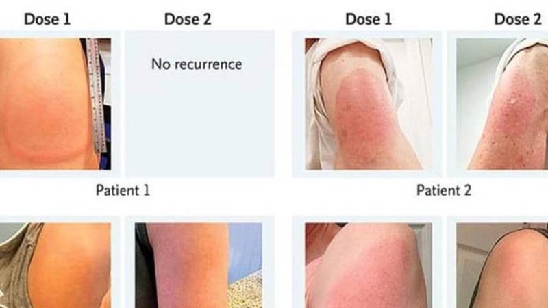 طفح جلدي احمر