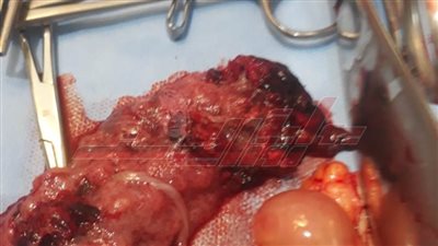 عمره 12 أسبوعا.. إزالة جنين خارج الرحم بكفر الشيخ