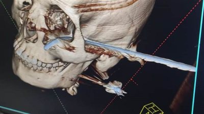 الرعاية الصحية تنجح في استخراج سيخ حديدي من رأس طفلة ببورسعيد