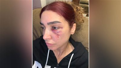 روجينا تطمئن جمهورها بعد إصابتها في 