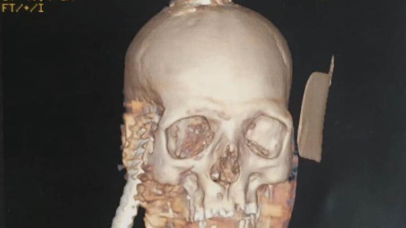 السيخ داخل الجمجمة