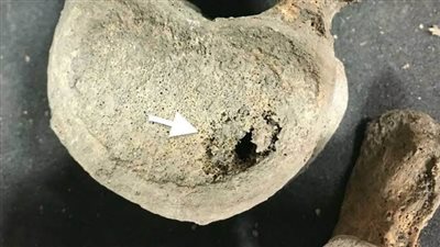 تحديد مستوى الإصابة بالسرطان في القرون الوسطى