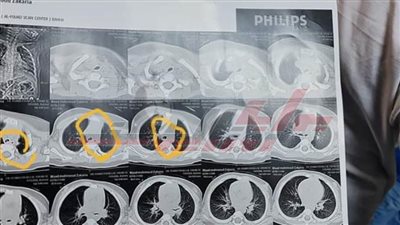 بنها الجامعى تنقذ حياة طفل ابتلع 