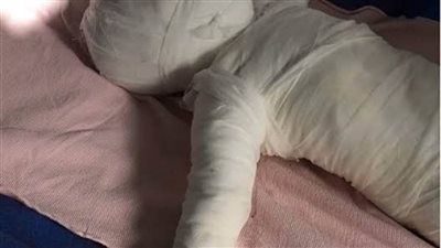 مصرع طفلة سقط عليها إناء مغلي في سوهاج