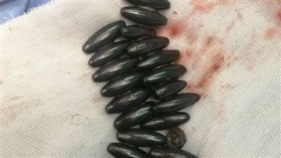 معجزة طبية.. فريق طبي بجامعة الزقازيق يستخرج 30 قطعة معدنية من أحشاء طفلة 