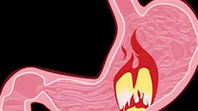 هل يتطور التهاب المعدة إلى سرطان؟