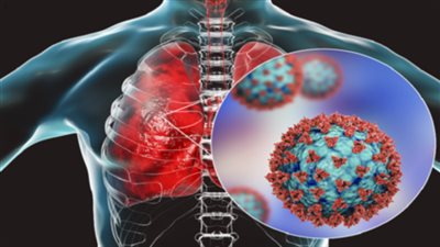 دراسة جديدة تؤكد تلف الرئة طويل الأمد بعد 