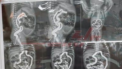 جراحة نادرة لطفل 