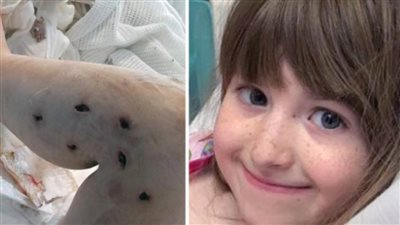 عاجل|  إجراء 7 عمليات جراحية  لطفلة شكتها 