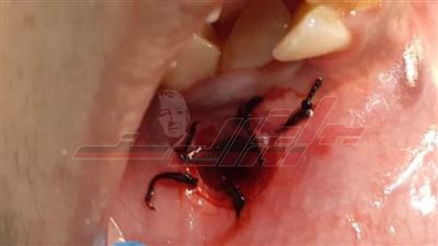 استئصال كيس من عظام الفك السفلي لمريضة بمستشفى جامعة بنها