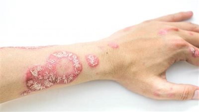 دراسة: وجود ارتباط بين ارتفاع مؤشر كتلة الجسم والإصابة بالصدفية