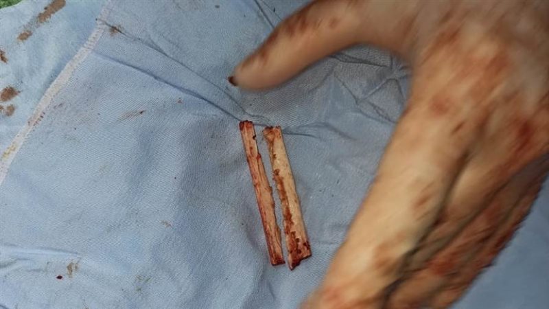 الورم السرطاني كان