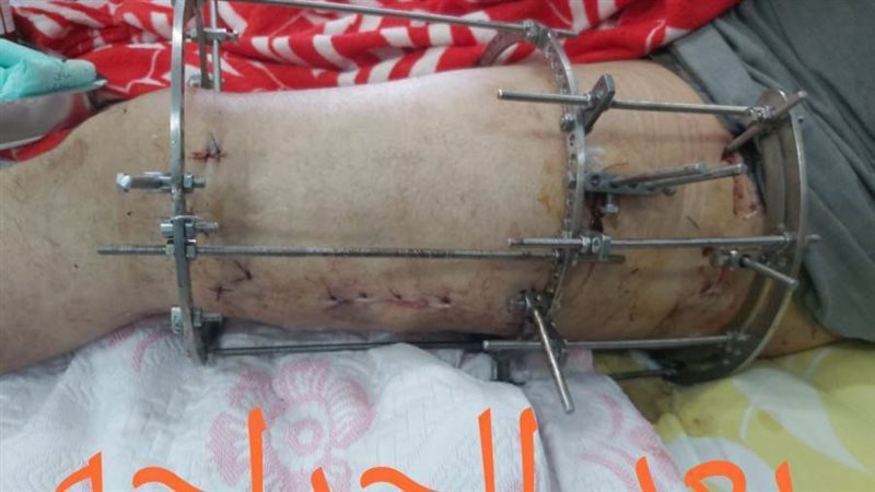 نجاح الجراحة