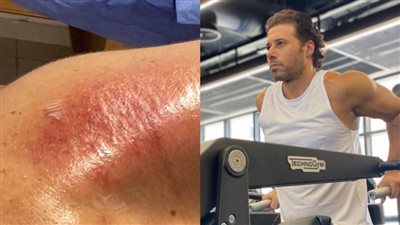 في الكتف والرقبة.. شاهد إصابة أحمد السعدني الخطيرة في الجيم 