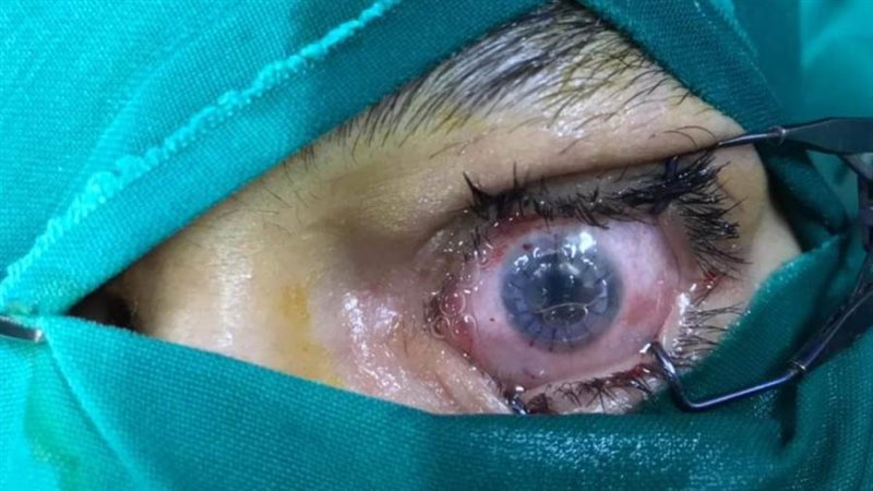 عملية زرع قرنيه برمد
