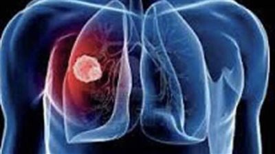 استشاري يكشف أسباب الإصابة بالمياه على الرئة وعلاقتها بـ