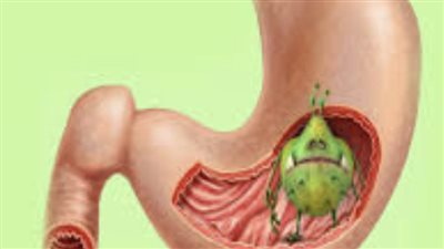 ‎استشاري يوضح طرق الحماية من جرثومة المعدة وأعراضها وعلاجها 