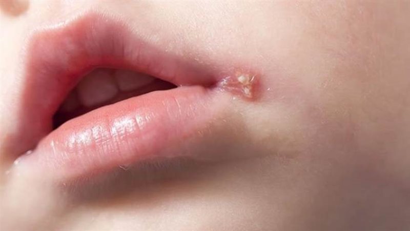 الهربس - أرشيفية