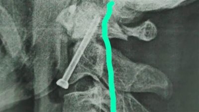 مستشفى سوهاج الجامعي تجري جراحة دقيقة بالعمود الفقري لشاب بعد سقوطه من أعلى نخلة 