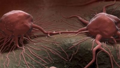 علماء بريطانيون يستخدمون الذكاء الاصطناعي لعلاج نوع نادر من سرطان الأطفال