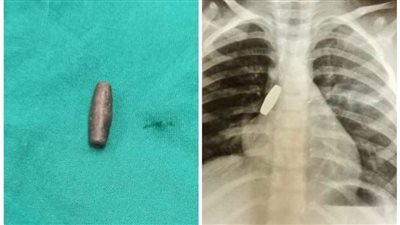 مستشفى ملوي التخصصي ينجح في إنقاذ طفلة ابتلعت رصاصة 