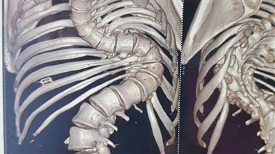 مستشفى أزهر أسيوط يجري عملية دقيقة لفتاة تعاني من اعوجاج بالعمود الفقري 