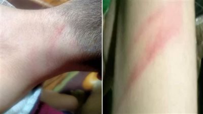 حجز الأم وزوجها العرفي في واقعة اتهامهما بضرب نجلها ببنها