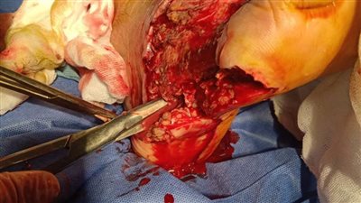 للمرة الأولى.. إجراء جراحة أوعية دموية بمستشفى بلبيس