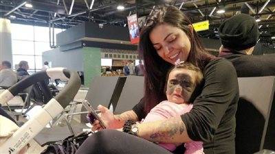 شاهد.. أطباء يتمكنون من إزالة وحمة 