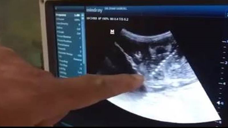 السونار يظهر نبض