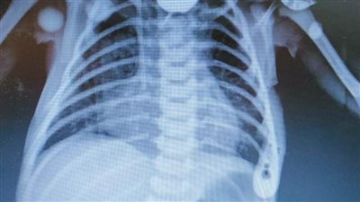 إنقاذ حياة طفل حديث الولادة من انسداد بالمريء بمستشفى عين شمس