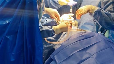 للمرة الأولى.. إجراء أول عملية مخ وأعصاب بمستشفى بلبيس بعد تكويده بقوائم الانتظار 