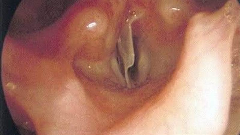 قشرة لب بالاحبال