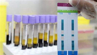  اكتشاف سلالة شديدة العدوى من فيروس نقص المناعة البشرية