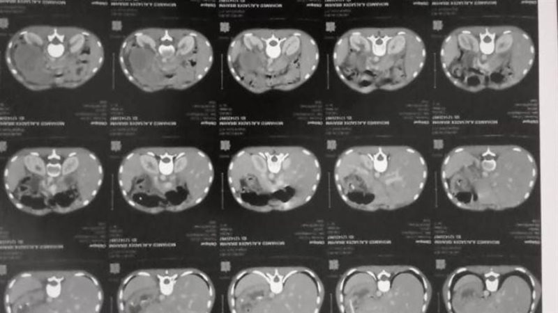 نجاح عملية جراحية