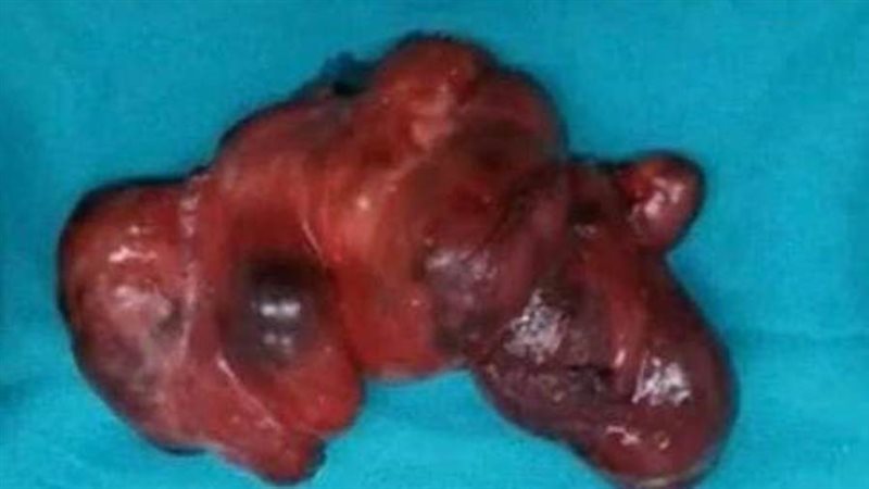 استئصال ورم سرطان