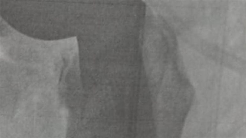 نجاح عملية تركيب