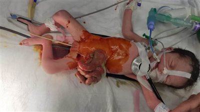 مستشفى ملوي التخصصي ينجح في إنقاذ 3 رضع بعد جراحات خطيرة لهم