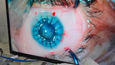 زرع قرنية كاملة لمريضة برمد المنيا ضمن مبادرة القضاء على قوائم الانتظار 