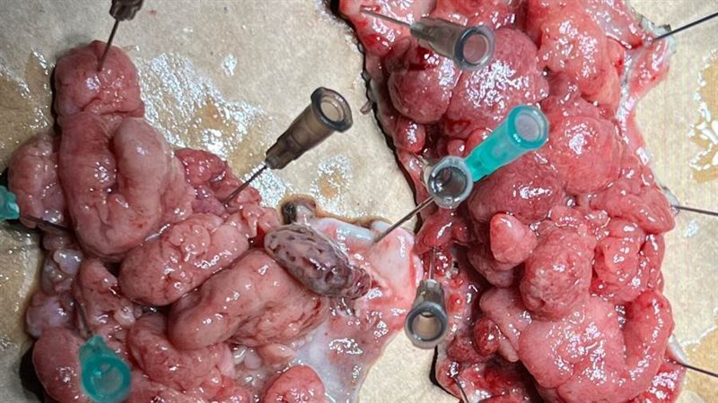 استئصال أورام بتقنية