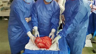 فريق طبي بمستشفى سوهاج الجامعي ينجح في استئصال ورم يزن ١٨ كجم 